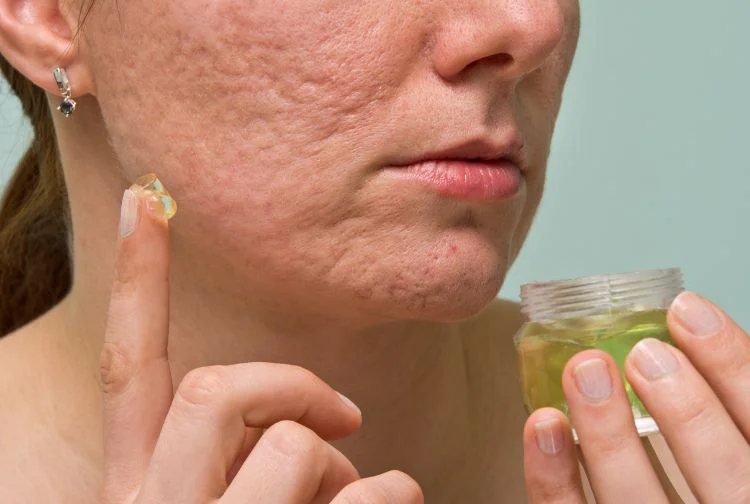 Chickenpox Scars & Pitted Scar Treatment