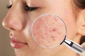 Acne & Acne Scar Treatment