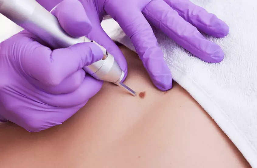 Mole & Wart Removal