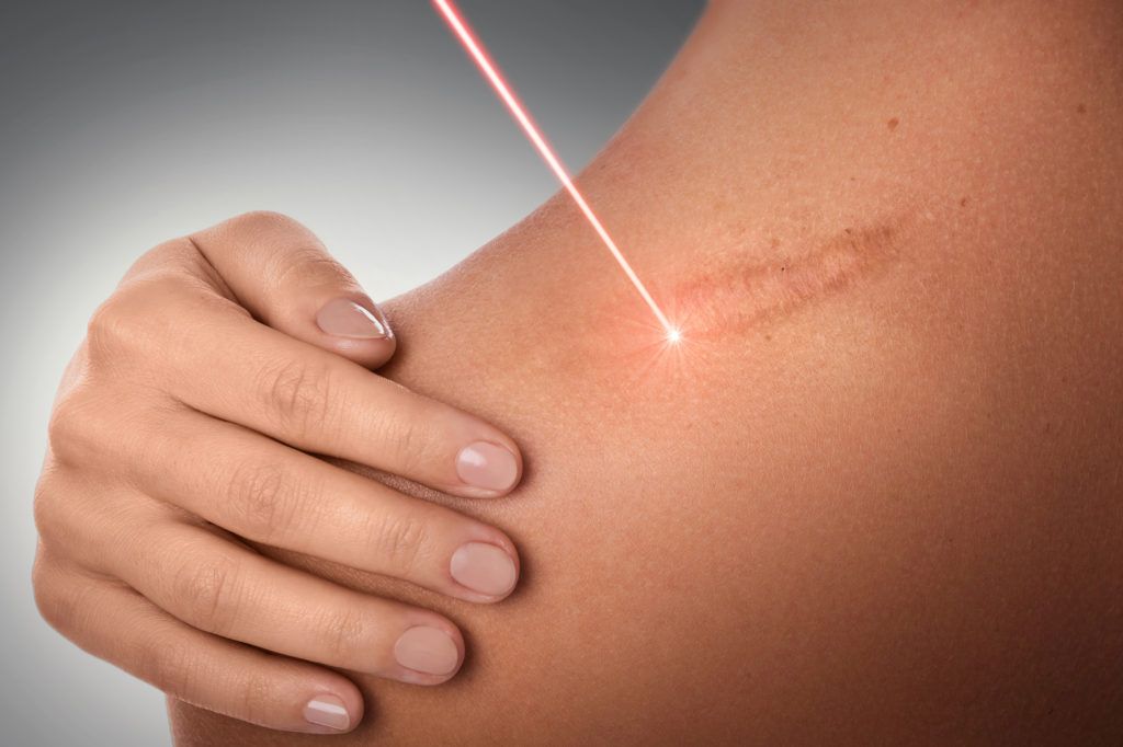 Burn & Cut Scar Removal