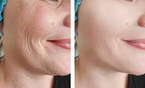 Wrinkles & Freckles Treatment